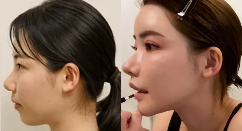 深田えいみ　横顔整形前後　画像